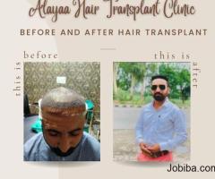 Hair Restoration and Affordable Best Hair Transplant Clinic in Chandigarh